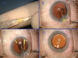 implanten hoya lens