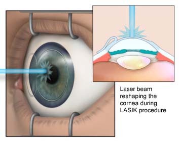 Lasik ogen laseren