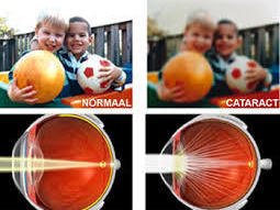 Cataract symptomen